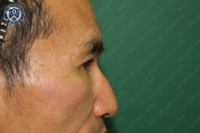 남자눈성형: 무쌍눈매교정 (Blephroptosis correction-levator aponeurosis advancement) 관련 이미지 28