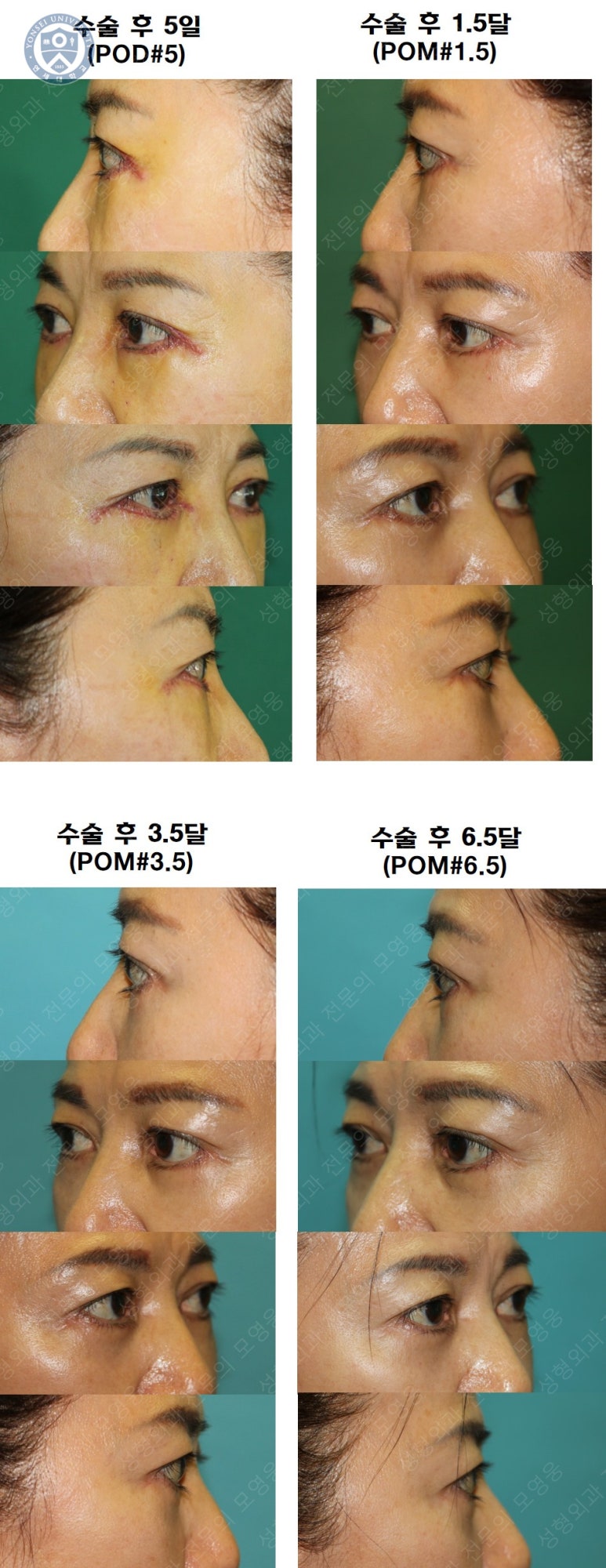 59세 여성, 그레이브스 안병증이 있는 돌출눈 중년 여성 하안검 성형술 (Lower blepharoplasty in Graves 관련 이미지 45