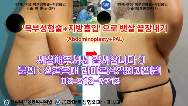 '복부성형술+지방흡입(Abdominoplasty+PAL)' 으로 뱃살 끝장내기! 관련 이미지 65