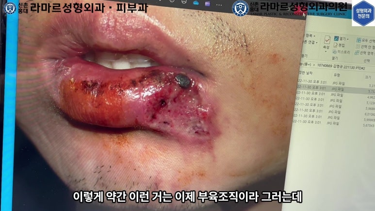 개에 물려 입술 1/3이 뜯긴 19세 남자분 치료 및 흉터 성형수술& 레이저 후기....! 관련 이미지 23