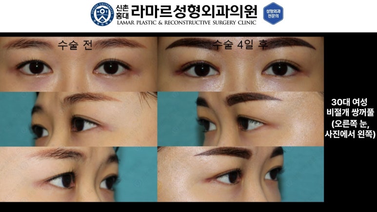 10대~30대 눈 수술 케이스 : 대표원장님 쌍꺼풀 전후 사진 모음 관련 이미지 18