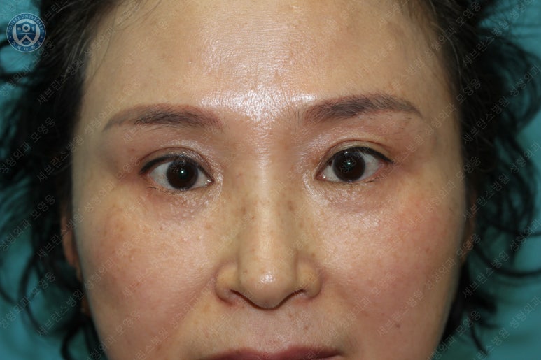 49세 여성, 토안이 있는 중년여성의 상안검성형술 (49/F, Upper blepharoplasty with lagophthalmos correction& LP) 관련 이미지 36