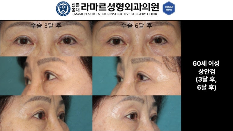 40대~80대 눈 수술 케이스 : 상안검성형술 전후 사진 모음 관련 이미지 17