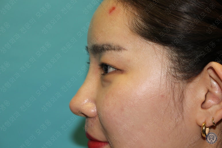 28세 여성 두줄따기, 눈밑지(28/F D.E.O & transconjunctival septal fat redraping) 관련 이미지 6