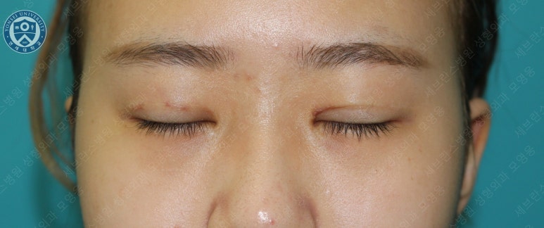 17세 여성, 비절개 눈매교정 및 앞트임 재수술 (17/F NI ptosis correction & Med. epicanthoplasty revision) 증례 관련 이미지 12