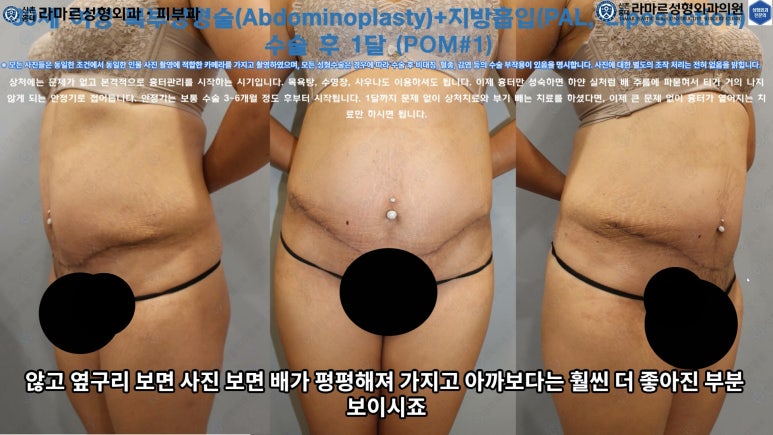 '복부성형술+지방흡입(Abdominoplasty+PAL)' 으로 뱃살 끝장내기! 관련 이미지 49