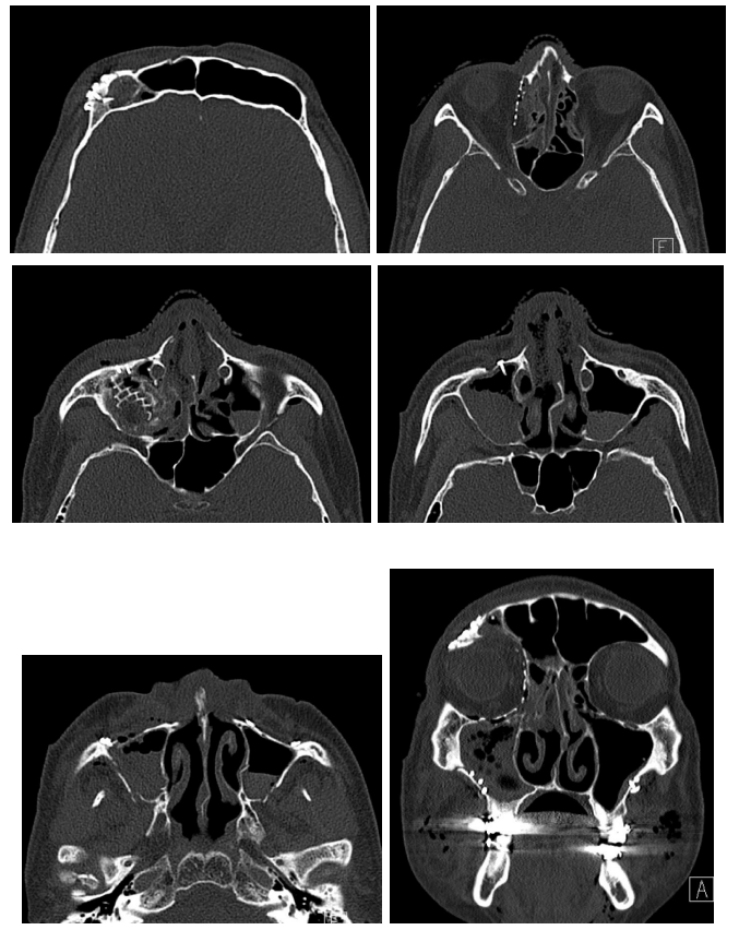 57세 남성, 얼굴 전체골절(57/M Panfacial bone fracture) 수술 및 흉터관리 증례 관련 이미지 14