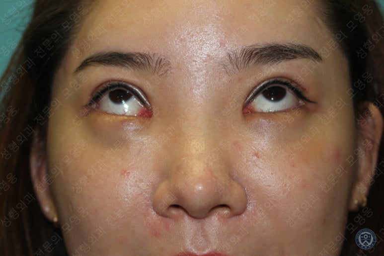 28세 여성 두줄따기, 눈밑지(28/F D.E.O & transconjunctival septal fat redraping) 관련 이미지 13