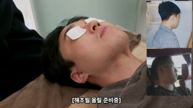 모영웅 대표원장 해초필링(FCR peeling) 피부관리영상...! 멍게피부가 사과피부가 되는 과정을 보여드립니다^^ 관련 이미지 24