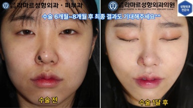 21세 여성 코 지름 1cm 점 제거수술 : 나선피판술(Spiral Flap) 수술전~5달 경과. (+쌍꺼풀수술, 코필러) 관련 이미지 6