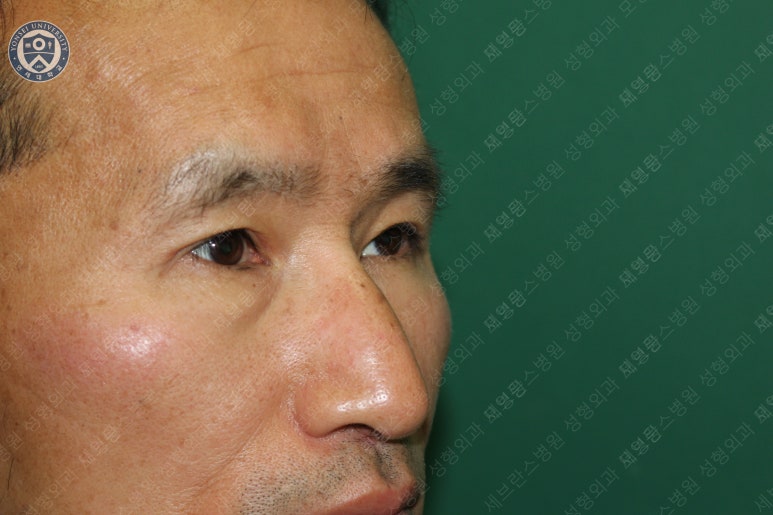 남자눈성형: 무쌍눈매교정 (Blephroptosis correction-levator aponeurosis advancement) 관련 이미지 35