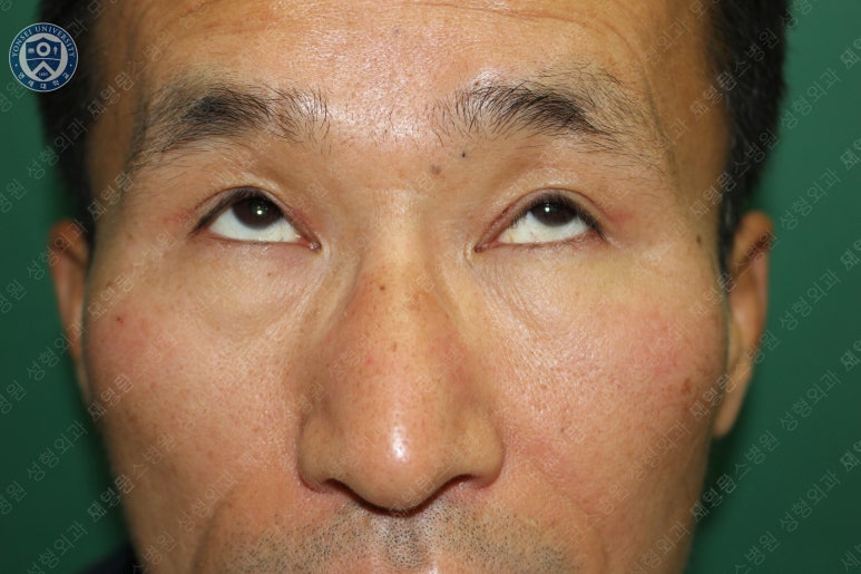 남자눈성형: 무쌍눈매교정 (Blephroptosis correction-levator aponeurosis advancement) 관련 이미지 32