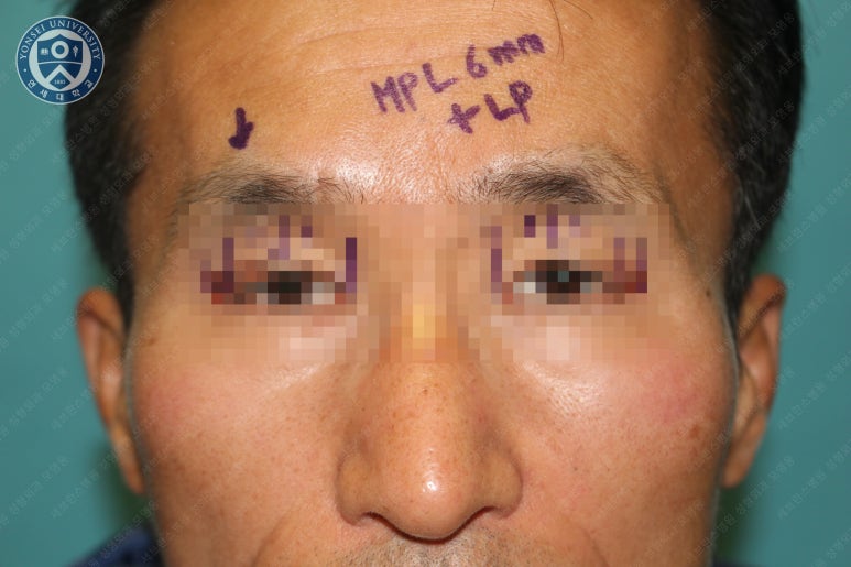 남자눈성형: 무쌍눈매교정 (Blephroptosis correction-levator aponeurosis advancement) 관련 이미지 18