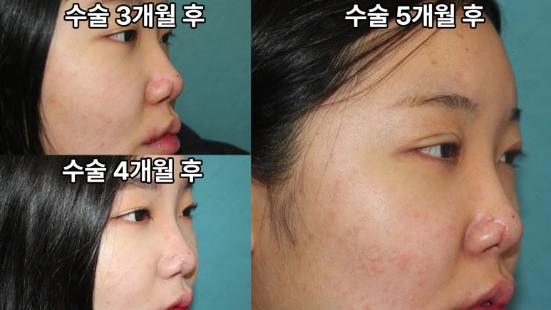 21세 여성 코 지름 1cm 점 제거수술 : 나선피판술(Spiral Flap) 수술전~5달 경과. (+쌍꺼풀수술, 코필러) 관련 이미지 9