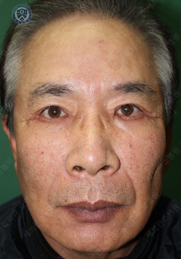 67세 남성, 상&middot;하안검성형술 및 안검하수교정 (67/M, Upper &  lower blepharoplasty with ptosis correction) 관련 이미지 28