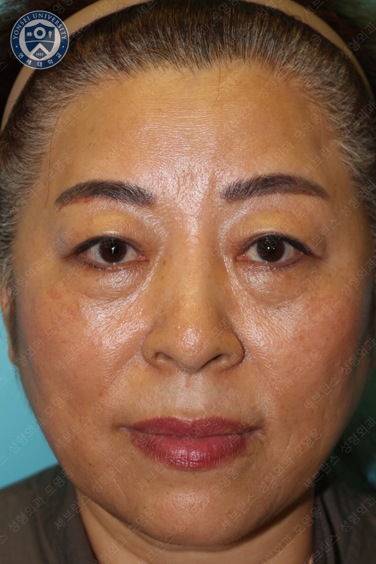 60세 여성, 상안검 및 하안검 성형술 증례 (60/F Upper & lower blepharoplasty) 관련 이미지 2