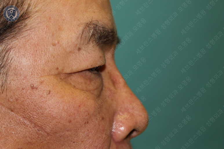 67세 남성, 상&middot;하안검성형술 및 안검하수교정 (67/M, Upper &  lower blepharoplasty with ptosis correction) 관련 이미지 15