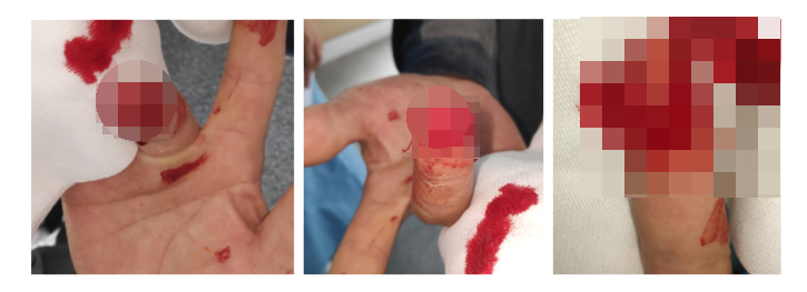 수지 말단부 절단에 시행한 동측 역행성 유경피판술 증례 (Homodigital Reverse Island Flap for Fingertip Amputation) 관련 이미지 3