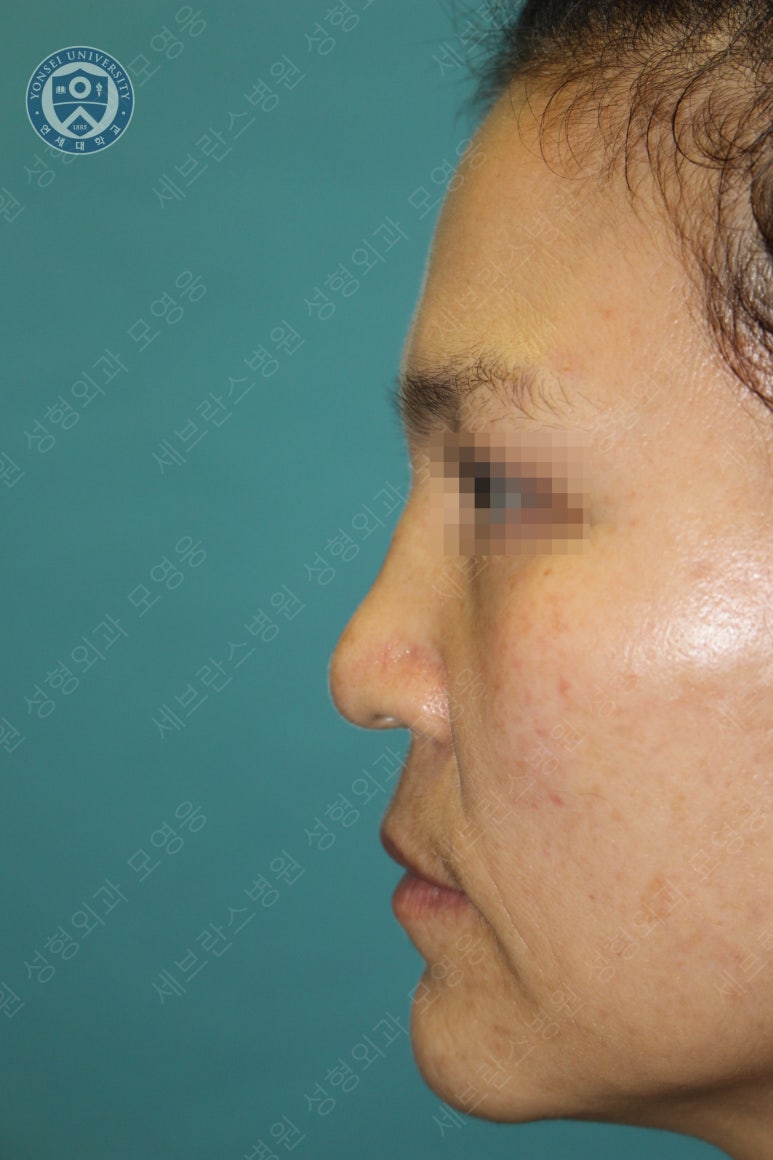 55세 여성, 이중평면 안면거상(55/F, Dual-plane full facelift) 관련 이미지 37