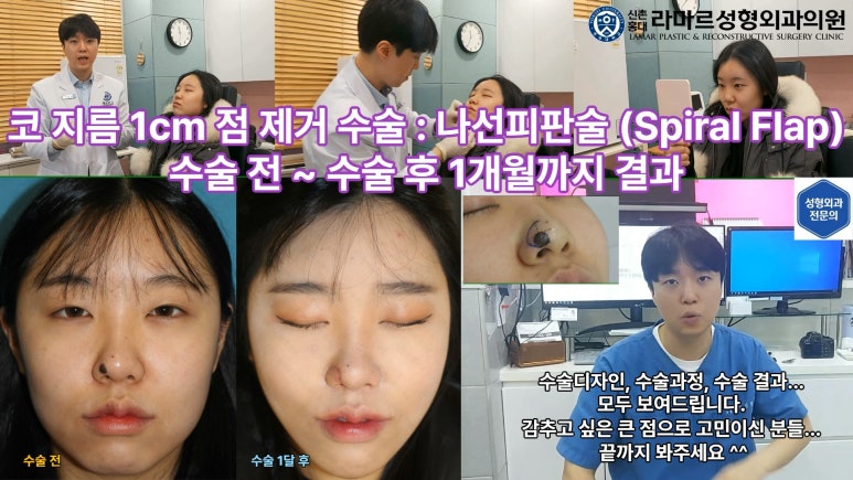 지름 1cm 코 점 제거수술 : 나선피판술(Spiral Flap) 수술전~1달 경과. (Feat. 턱끝필러+사각턱 보톡스) 관련 이미지 12