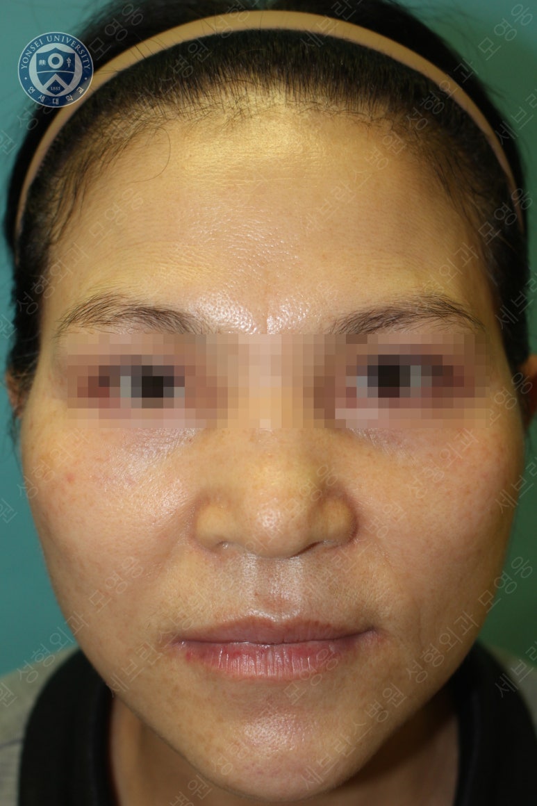 55세 여성, 이중평면 안면거상(55/F, Dual-plane full facelift) 관련 이미지 36
