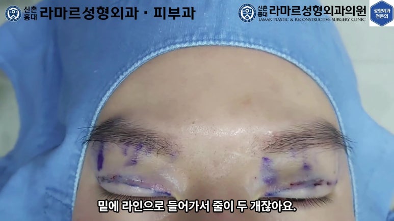 29세 남자, 소시지 쌍꺼풀 두줄따기로 낮추기 (쌍꺼풀 재수술) 관련 이미지 24