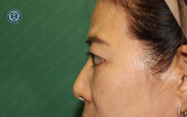 59세 여성, 그레이브스 안병증이 있는 돌출눈 중년 여성 하안검 성형술 (Lower blepharoplasty in Graves 관련 이미지 21