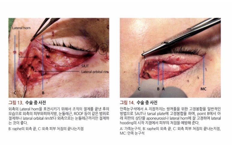 55세 여성, 상안검 및 하안검 성형술 증례 (55/F Upper & lower blepharoplasty) 관련 이미지 12