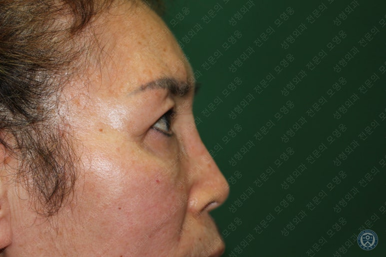64세 여성 상안검성형술+눈매교정 (64/F Upper blepharoplasty with ptosis correction) 관련 이미지 41