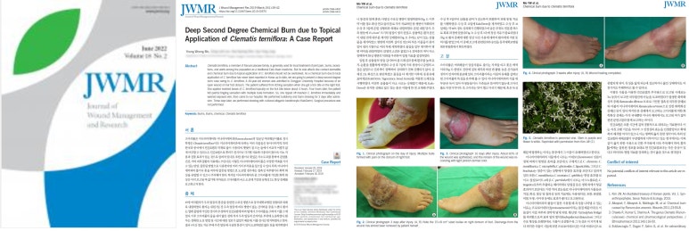 JWMR -Deep Second Degree Chemical Burn due to Topical Application of Clematis terniflora 관련 이미지 4