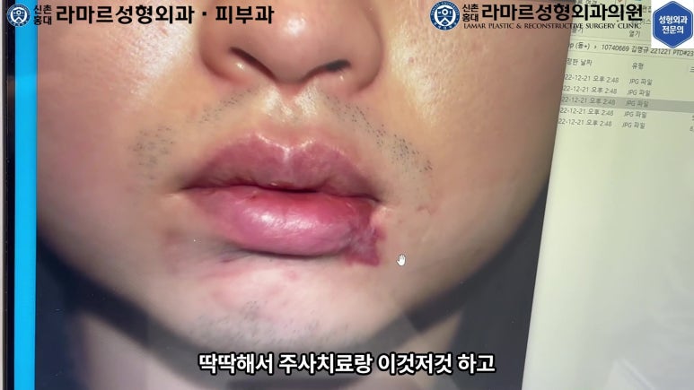 개에 물려 입술 1/3이 뜯긴 19세 남자분 치료 및 흉터 성형수술& 레이저 후기....! 관련 이미지 28