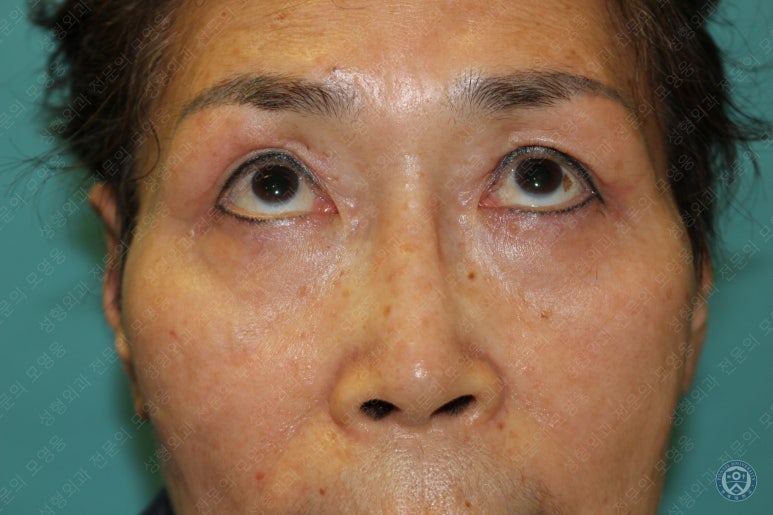 64세 여성 상안검성형술+눈매교정 (64/F Upper blepharoplasty with ptosis correction) 관련 이미지 29