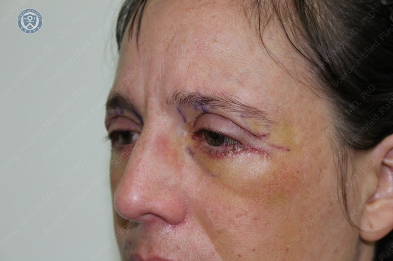 38세 서양 백인 여성, 쌍꺼풀 수술과 눈매교정 및 하안검성형술 (38/F Upper&lower blepharoplasty with levator plication) 관련 이미지 17