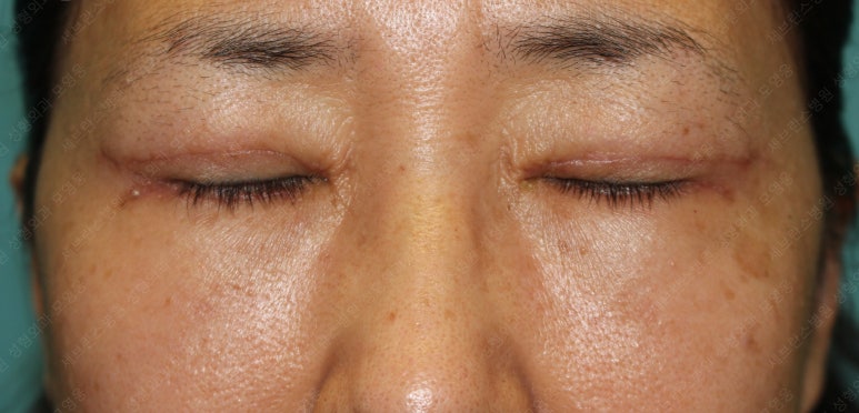55세 여성, 상안검 및 하안검 성형술 증례 (55/F Upper & lower blepharoplasty) 관련 이미지 14