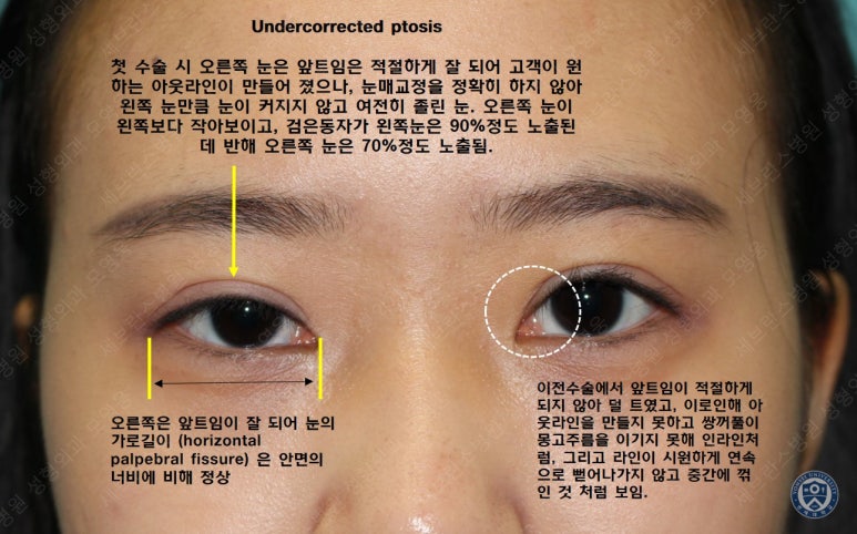17세 여성, 비절개 눈매교정 및 앞트임 재수술 (17/F NI ptosis correction & Med. epicanthoplasty revision) 증례 관련 이미지 5