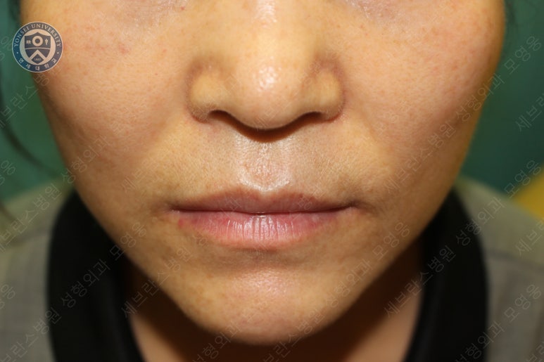 55세 여성, 이중평면 안면거상(55/F, Dual-plane full facelift) 관련 이미지 49