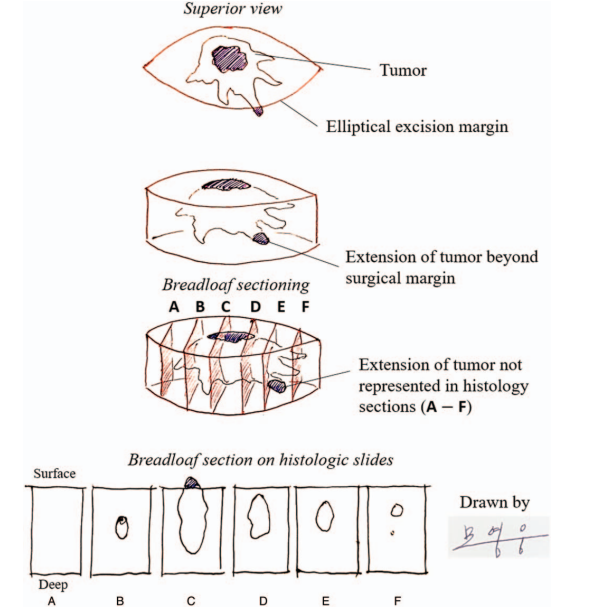 Medicine - Comparison of the recurrence rate of 3 treatmentmodalities for BD in an aging city 관련 이미지 18