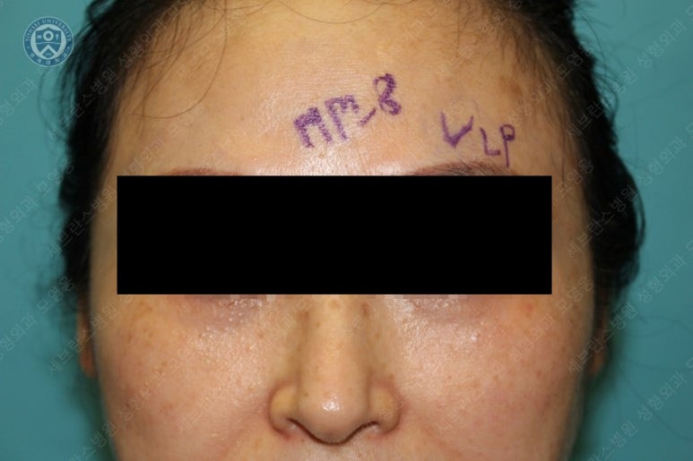 49세 여성, 토안이 있는 중년여성의 상안검성형술 (49/F, Upper blepharoplasty with lagophthalmos correction& LP) 관련 이미지 12