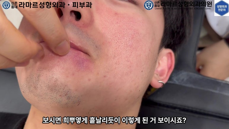 개에 물려 입술 1/3이 뜯긴 19세 남자분 치료 및 흉터 성형수술& 레이저 후기....! 관련 이미지 79