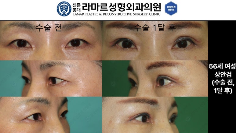40대~80대 눈 수술 케이스 : 상안검성형술 전후 사진 모음 관련 이미지 13