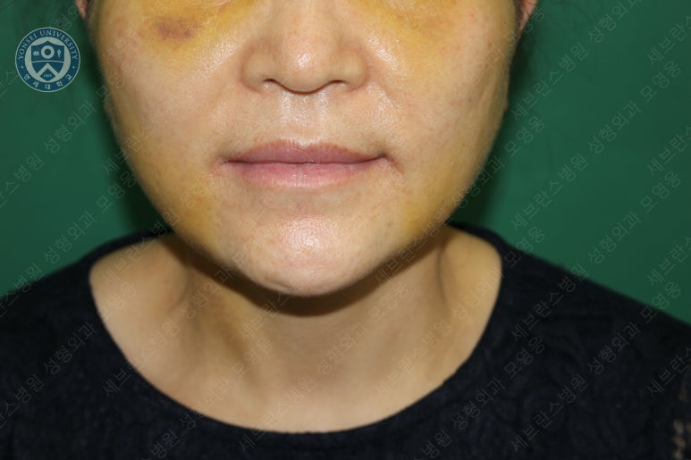 55세 여성, 이중평면 안면거상(55/F, Dual-plane full facelift) 관련 이미지 25