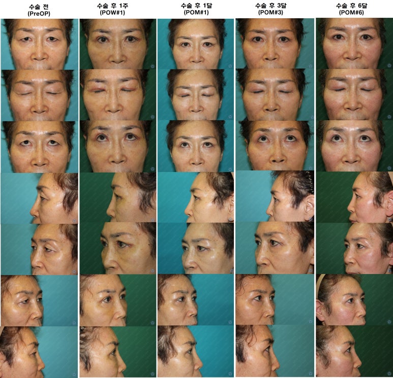 64세 여성 상안검성형술+눈매교정 (64/F Upper blepharoplasty with ptosis correction) 관련 이미지 45