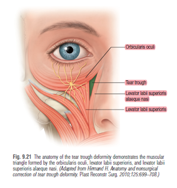 28세 여성, 눈밑지방재배치(눈밑지, 28/F Transconjunctival septal fat redraping-internal fixation technique) 관련 이미지 10