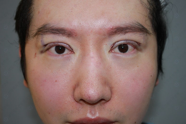 29세 남자, 소시지 쌍꺼풀 두줄따기로 낮추기 (쌍꺼풀 재수술) 관련 이미지 78