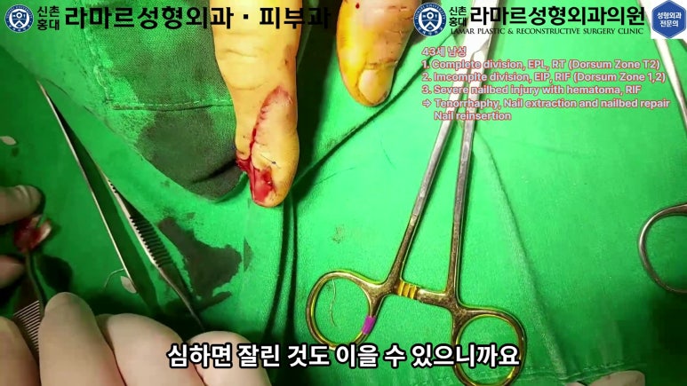 손가락 힘줄 손상 및 열상, 손톱 바닥 열상 처치 (Extensor tendon repair and nailbed injury treatment) 관련 이미지 18
