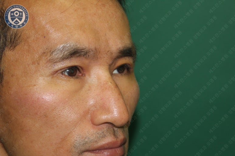 남자눈성형: 무쌍눈매교정 (Blephroptosis correction-levator aponeurosis advancement) 관련 이미지 27