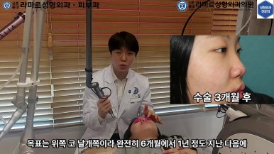21세 여성 코 지름 1cm 점 제거수술 : 나선피판술(Spiral Flap) 수술전~5달 경과. (+쌍꺼풀수술, 코필러) 관련 이미지 40