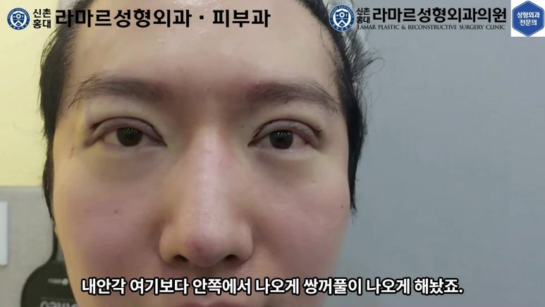 29세 남자, 소시지 쌍꺼풀 두줄따기로 낮추기 (쌍꺼풀 재수술) 관련 이미지 64