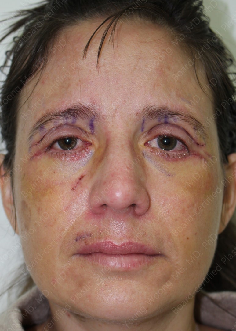 38세 서양 백인 여성, 쌍꺼풀 수술과 눈매교정 및 하안검성형술 (38/F Upper&lower blepharoplasty with levator plication) 관련 이미지 12
