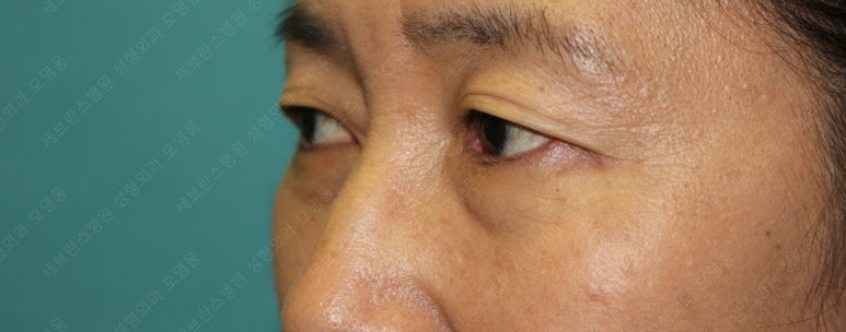 55세 여성, 상안검 및 하안검 성형술 증례 (55/F Upper & lower blepharoplasty) 관련 이미지 6